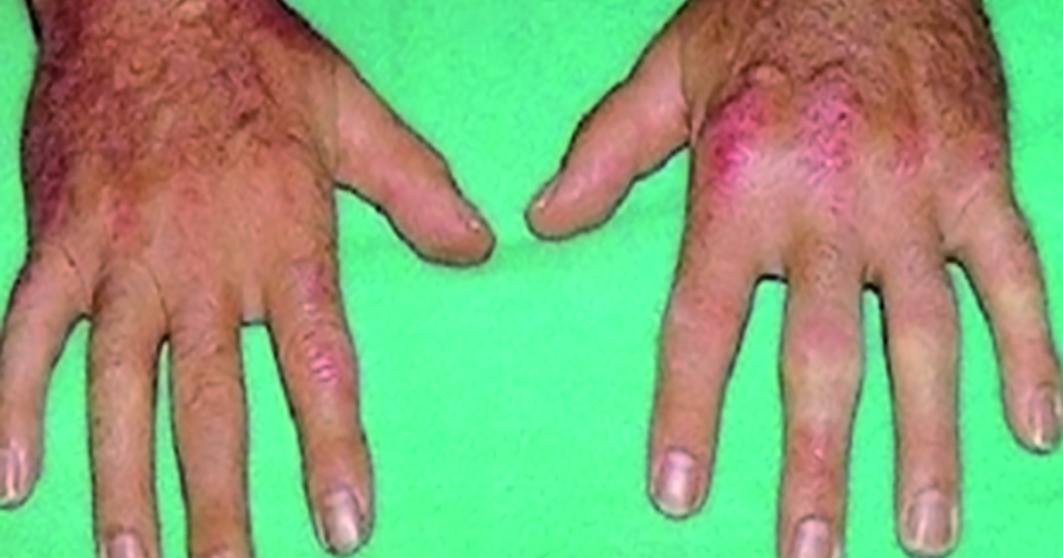 Que puede influir sobre la psoriasis